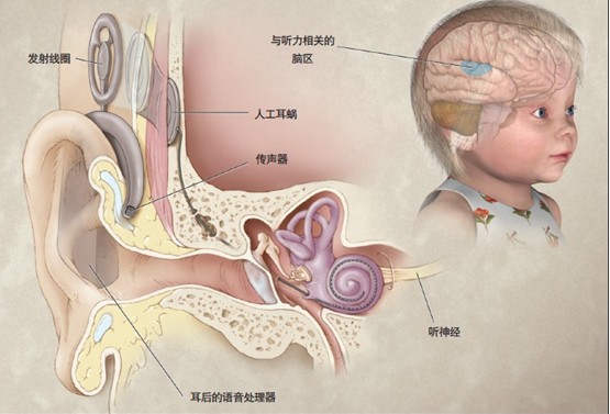 人工电子耳蜗