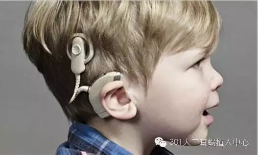 人工耳蜗通往有声世界的“桥梁”
