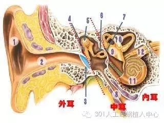 人工耳蜗通往有声世界的“桥梁”