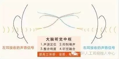 1+12！ 人工耳蜗双侧聆听的优势你不能错过！