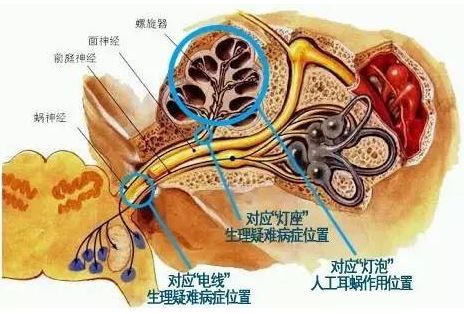 灯座坏了还是灯泡坏了？影响人工耳蜗术后效果的病症都有哪些？